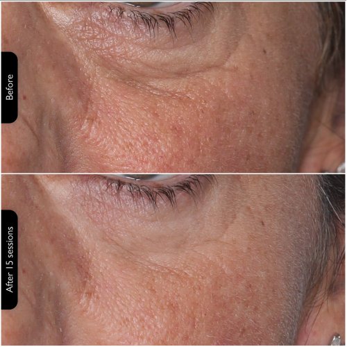 Silk'n Facial LED Mask 100 LEDS 